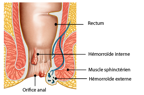 Les hémorroïdes durant la grossesse et après l'accouchement ...